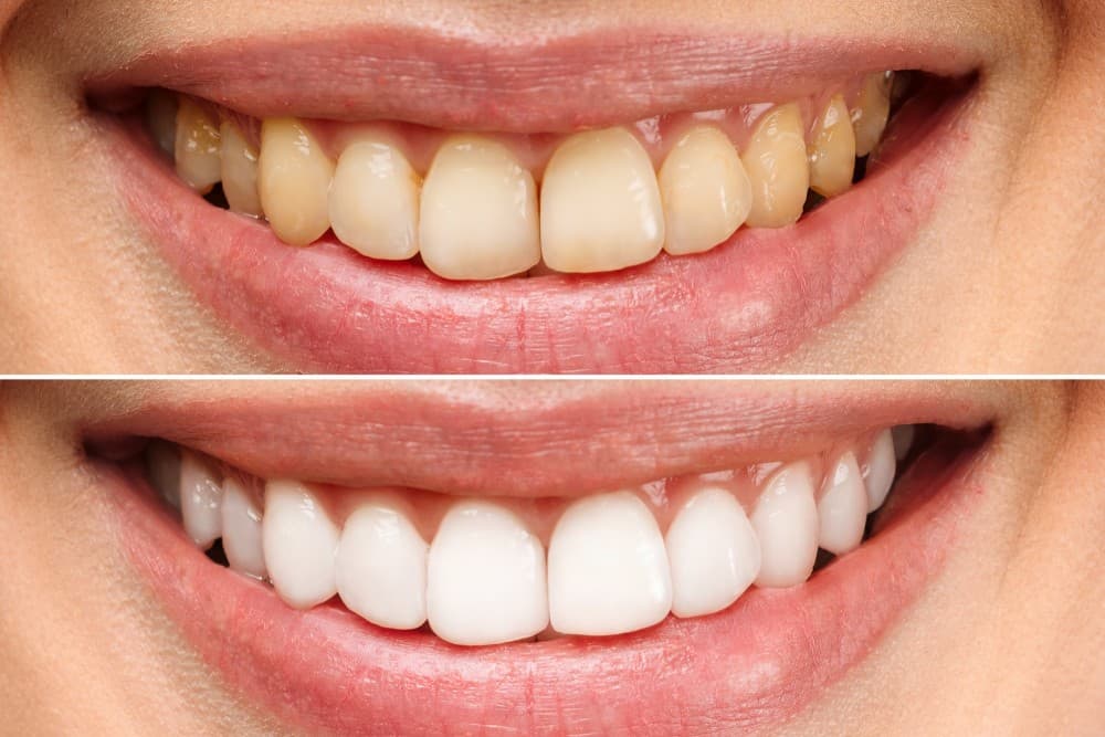 چگونه دندان کامپوزیت شده را سفید کنیم