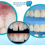 +10 عوارض کامپوزیت دندان + راه های مراقبت و پیشگیری