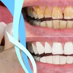 فرق جرمگیری لثه با جرمگیری دندان چیست؟ [روش و ابزارها]
