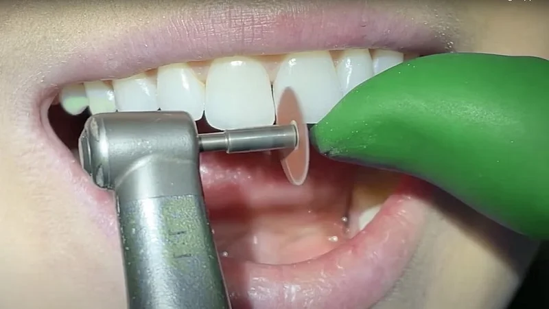 تراشیدن دندان‌ها برای نصب کامپوزیت
