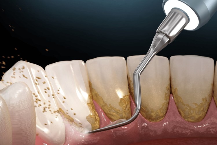 جرمگیری دندان چیست و چه فوایدی دارد؟